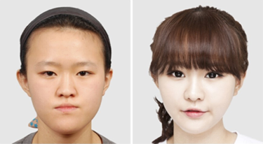 Percayakah kamu 15 foto ini semua hasil operasi plastik?