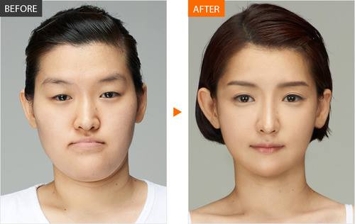 Percayakah kamu 15 foto ini semua hasil operasi plastik?