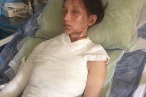 Wanita ini diguyur air panas usai menilai buruk pelayanan restoran