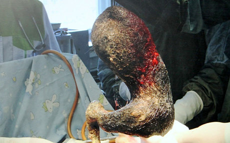 10 Benda yang ditemukan dalam tubuh manusia, bikin merinding ya?