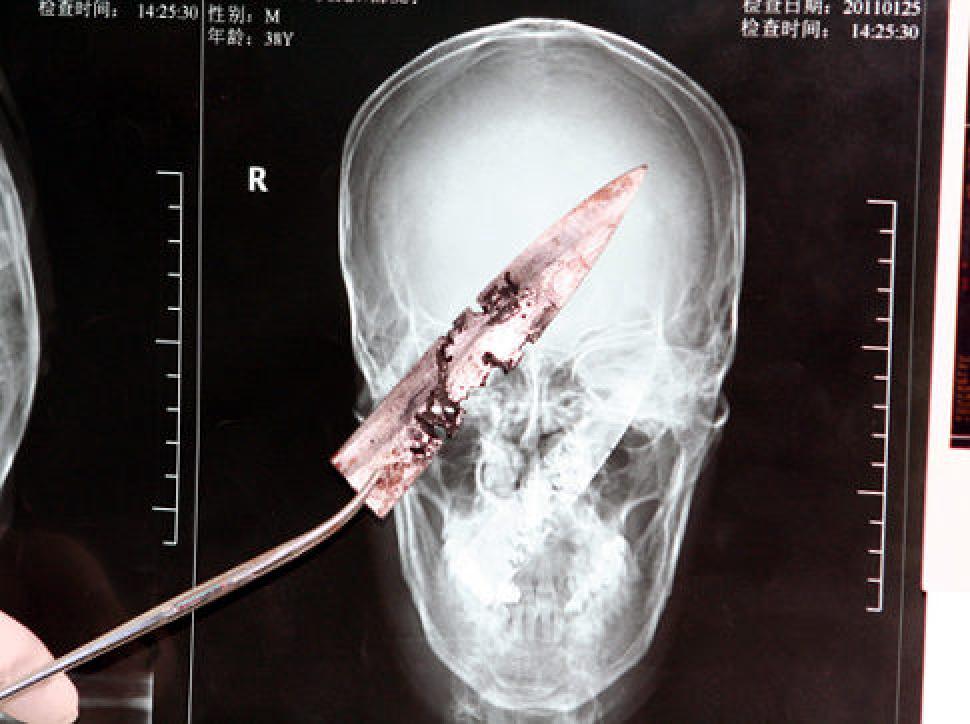 10 Benda yang ditemukan dalam tubuh manusia, bikin merinding ya?