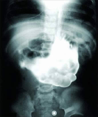 10 Benda yang ditemukan dalam tubuh manusia, bikin merinding ya?