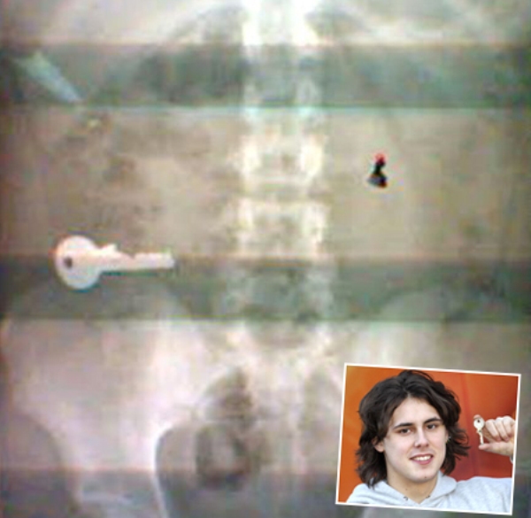 10 Benda yang ditemukan dalam tubuh manusia, bikin merinding ya?