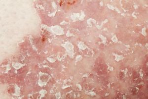Mengenal penyakit psoriasis, pasiennya berisiko mengalami depresi