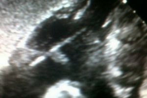 Tusuk gigi bersarang di jantung pria ini selama 1 tahun, ngeri!