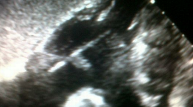 Tusuk gigi bersarang di jantung pria ini selama 1 tahun, ngeri!