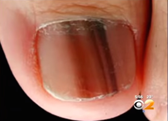 Waspadai garis hitam di kuku, bisa jadi itu gejala kanker!