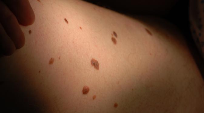 Hati-hati, tahi lalat di lengan kanan bisa jadi tanda kanker kulit!