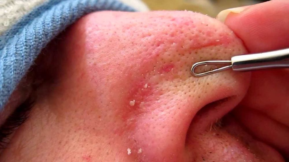 6 'Kesaktian' bawang putih, bikin wajahmu terjamin sehat bebas jerawat 6 'Kesaktian' bawang putih, bikin wajahmu terjamin sehat bebas jerawat