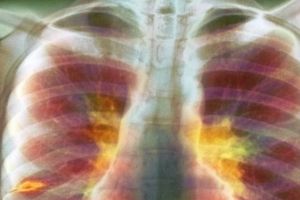 Penelitian terbaru WHO: TBC jadi penyakit paling mematikan setelah HIV