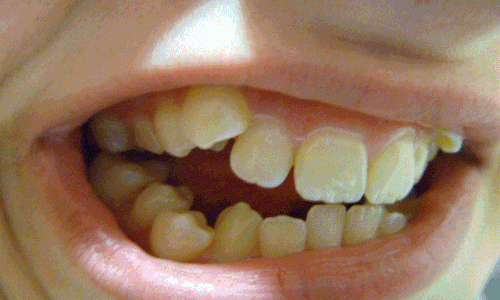 6 Kondisi kesehatan gigi yang sangat berbahaya jika kamu abaikan