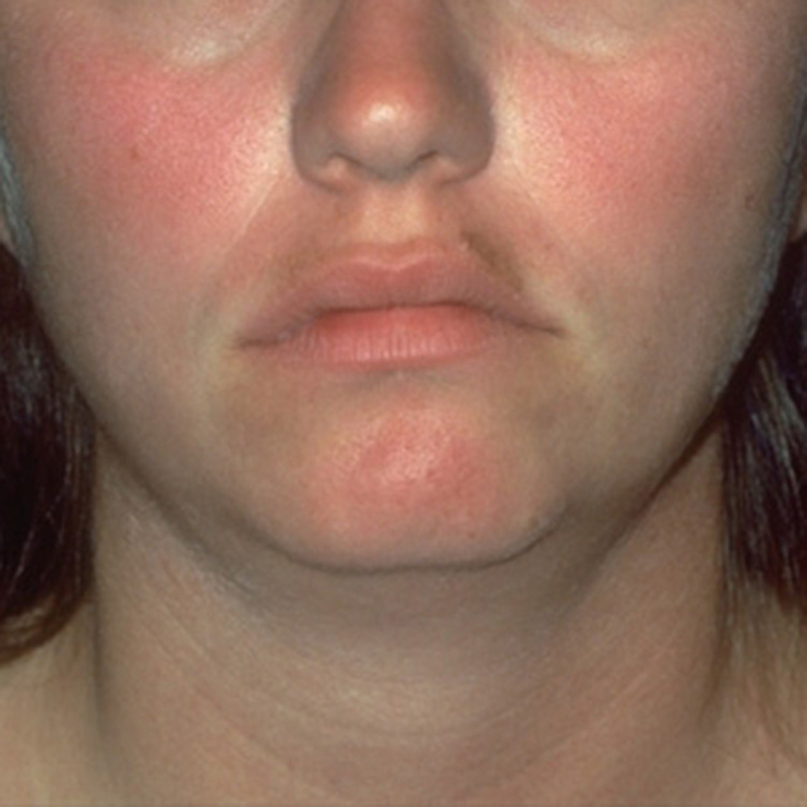 6 Penyakit kulit yang mengintai wajah mulusmu, bikin nggak cantik lagi