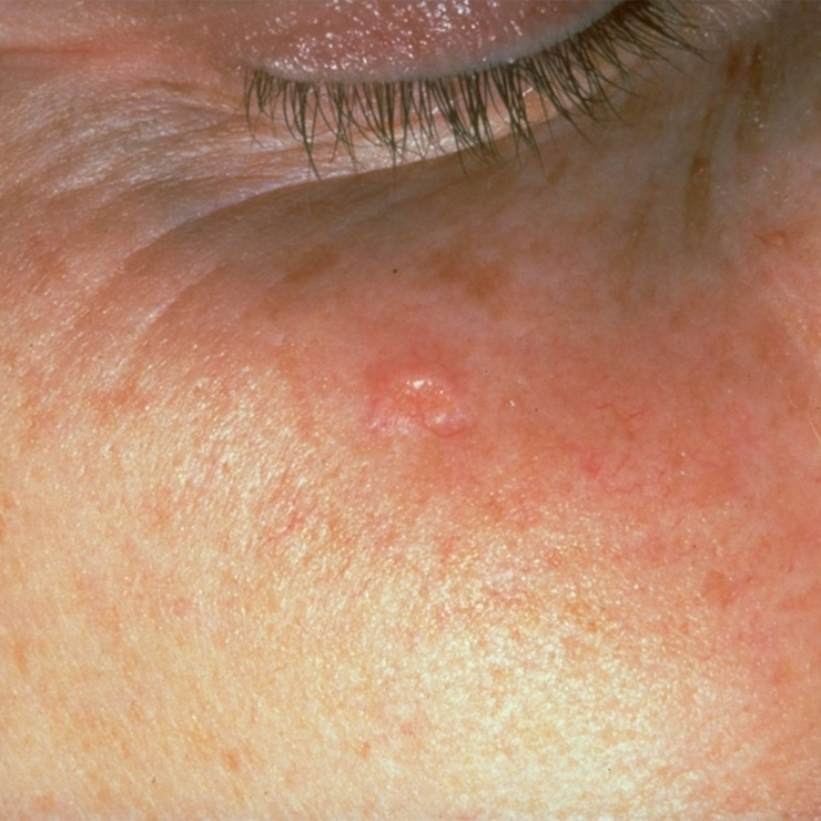 6 Penyakit kulit yang mengintai wajah mulusmu, bikin nggak cantik lagi