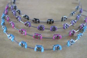 Pakai behel cuma buat gaya-gayaan bahaya nggak sih? Ini penjelasannya