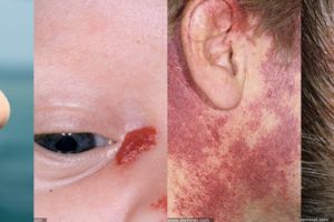 10 Macam tanda lahir dan arti buat kesehatan, kamu punya nggak?