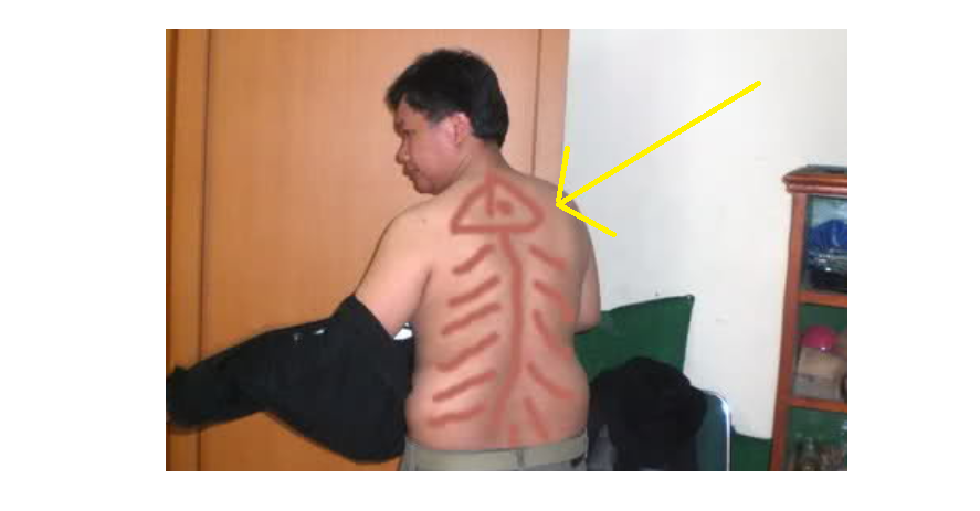 11 Gaya kerokan ini paling lucu, bikin ngakak sampai perut mules!