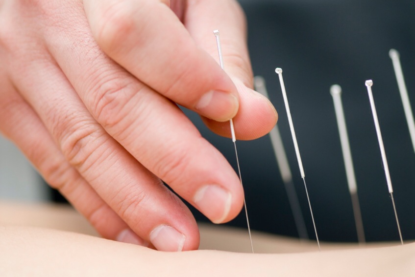 7 Tanda kamu harus coba Akupunktur, sangat mustajab hilangkan sakit!
