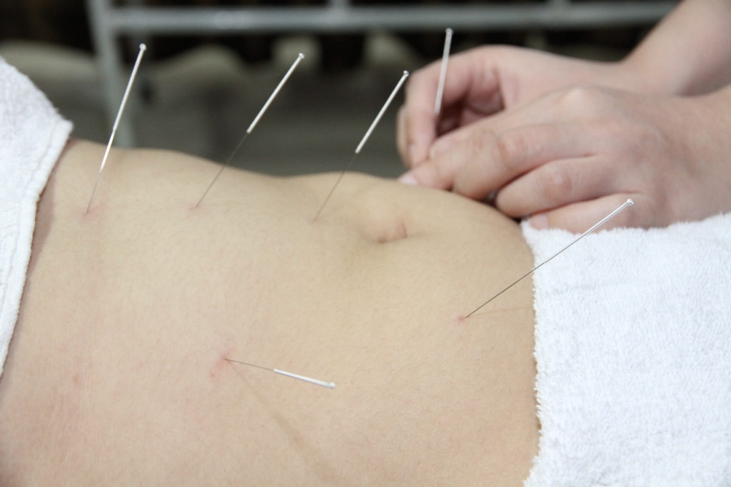 7 Tanda kamu harus coba Akupunktur, sangat mustajab hilangkan sakit!