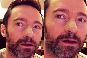 Hidung Hugh Jackman diplester, kenapa ya?