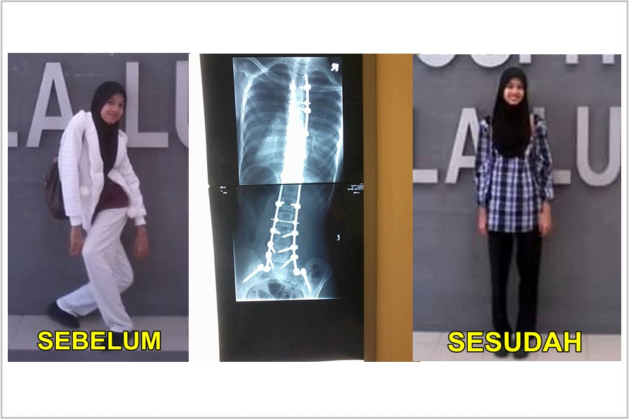 Beruntungnya gadis ini, kakinya kembali tegap usai operasi 3 tahun