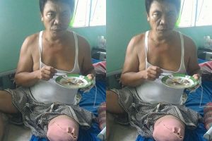 Ingin kembali beraktivitas, Rozali butuh bantuan kaki palsu