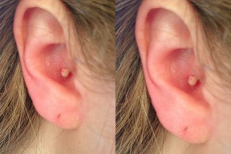 Ini alasan nggak boleh mencetin jerawat di telinga!