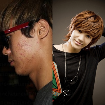 Terlalu sering pakai make up, wajah 10 idola K-Pop ini jerawatan, duh!