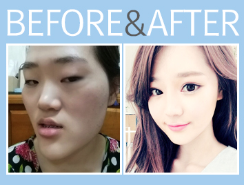 keajaiban oplas korea © 2016 brilio.net keajaiban oplas korea © 2016 brilio.net