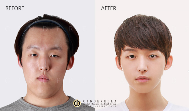 keajaiban oplas korea © 2016 brilio.net keajaiban oplas korea © 2016 brilio.net