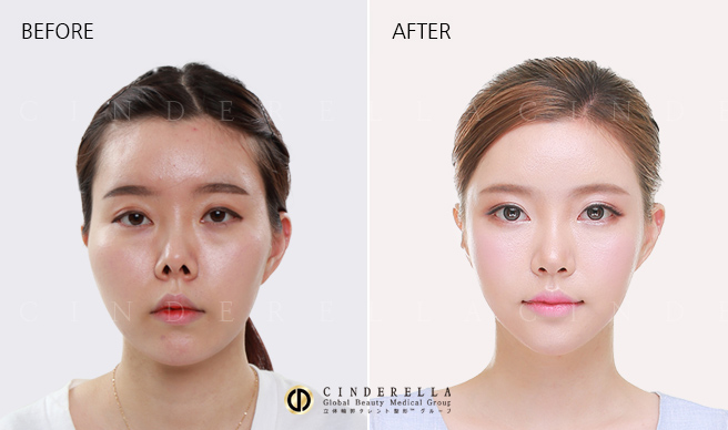 keajaiban oplas korea © 2016 brilio.net keajaiban oplas korea © 2016 brilio.net