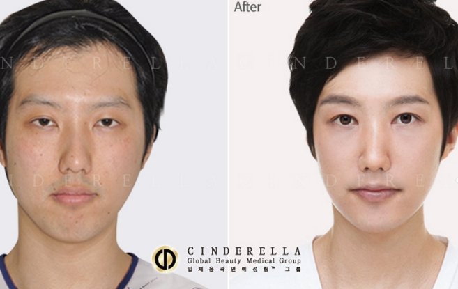 keajaiban oplas korea © 2016 brilio.net keajaiban oplas korea © 2016 brilio.net