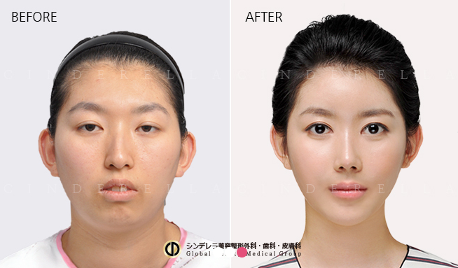 keajaiban oplas korea © 2016 brilio.net keajaiban oplas korea © 2016 brilio.net