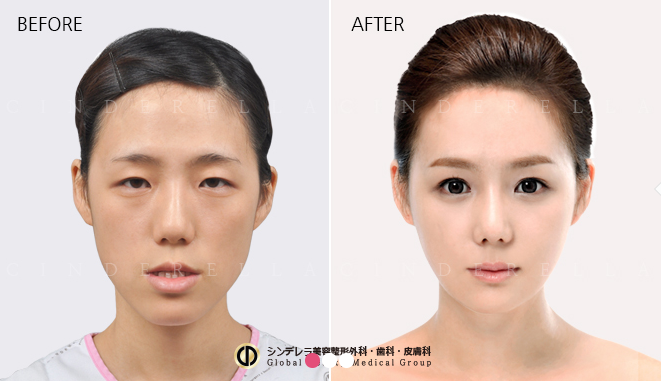 keajaiban oplas korea © 2016 brilio.net keajaiban oplas korea © 2016 brilio.net