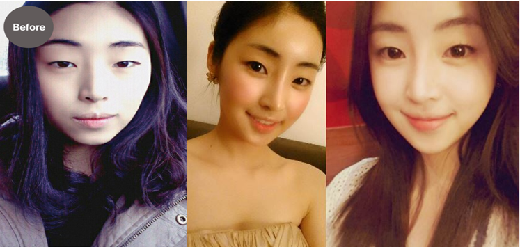 keajaiban oplas korea © 2016 brilio.net keajaiban oplas korea © 2016 brilio.net