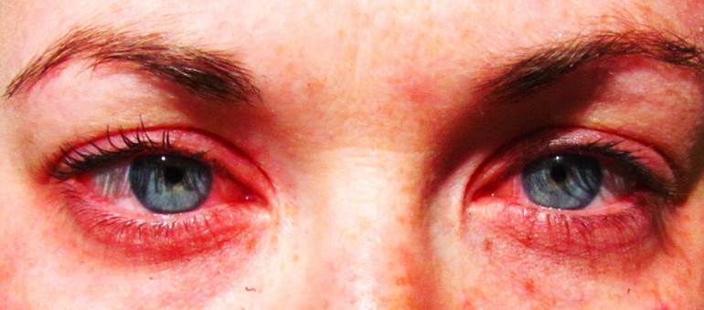 10 Beda mata merah akibat nangis & iritasi, nggak bisa bohong lagi deh