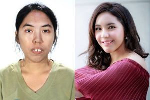 10 Before-after cewek Thailand usai operasi plastik, pangling nggak?