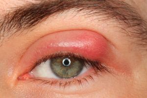 Benarkah bintitan karena mengintip? Ini 7 fakta & mitos bintitan