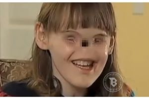 Lahir tanpa hidung & mata, gadis ini tetap mampu berprestasi