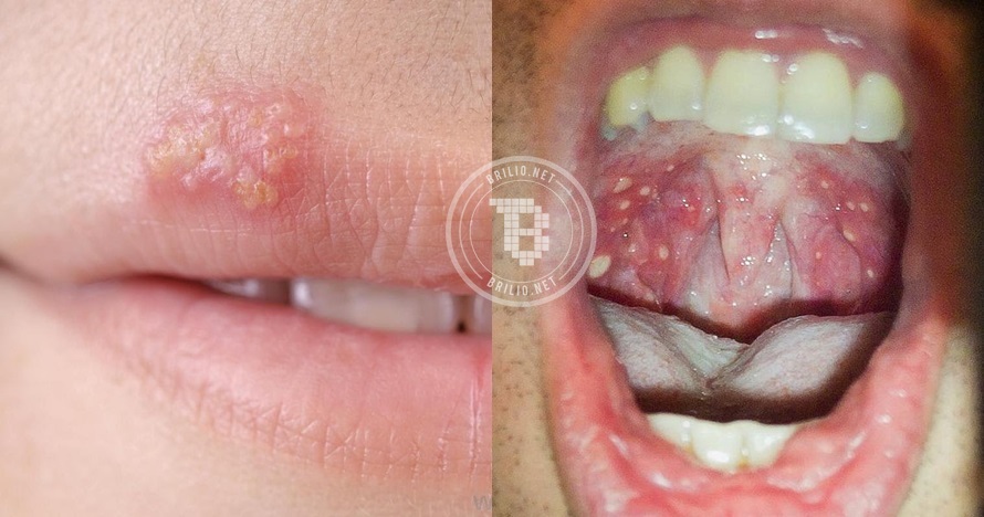 8 Penyakit ini bisa kamu idap cuma gara-gara ciuman bibir, bahaya nih!