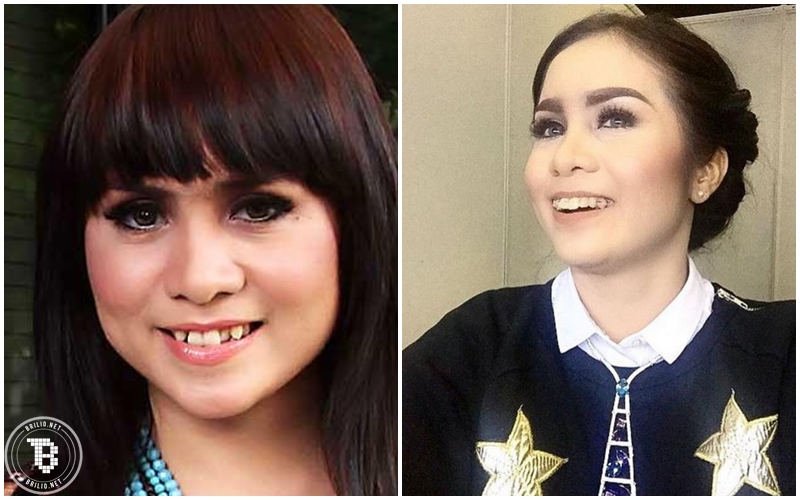 15 Artis dengan senyum menawan ini ternyata pernah permak gigi lho