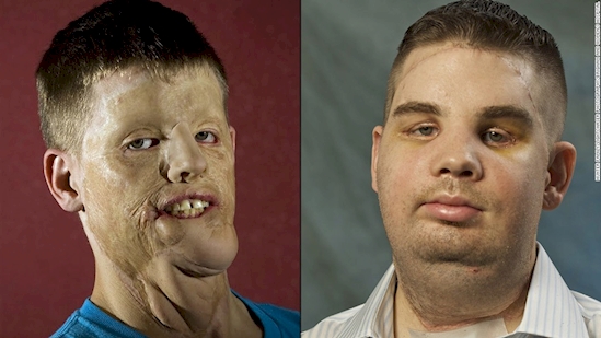 Ini transformasi dari transplantasi wajah korban kecelakaan, ngeri! 