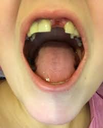 (Kesehatan) Awas! 13 penyakit ini bisa menyerang jika kamu tidak menjaga kebersihan gigi. © 2016 brilio.net