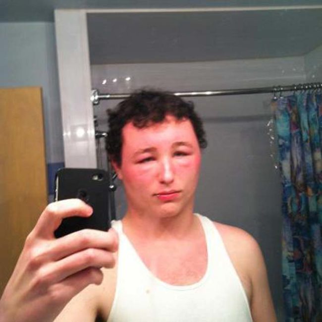 reaksi alergi © 2016 brilio.net reaksi alergi © 2016 brilio.net