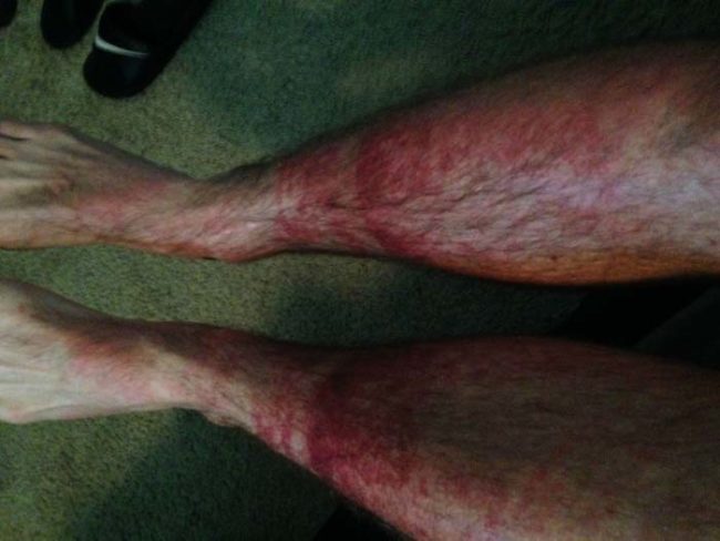 reaksi alergi © 2016 brilio.net reaksi alergi © 2016 brilio.net