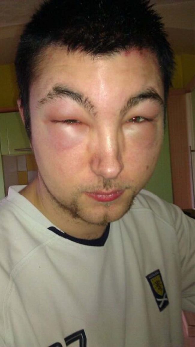 reaksi alergi © 2016 brilio.net reaksi alergi © 2016 brilio.net