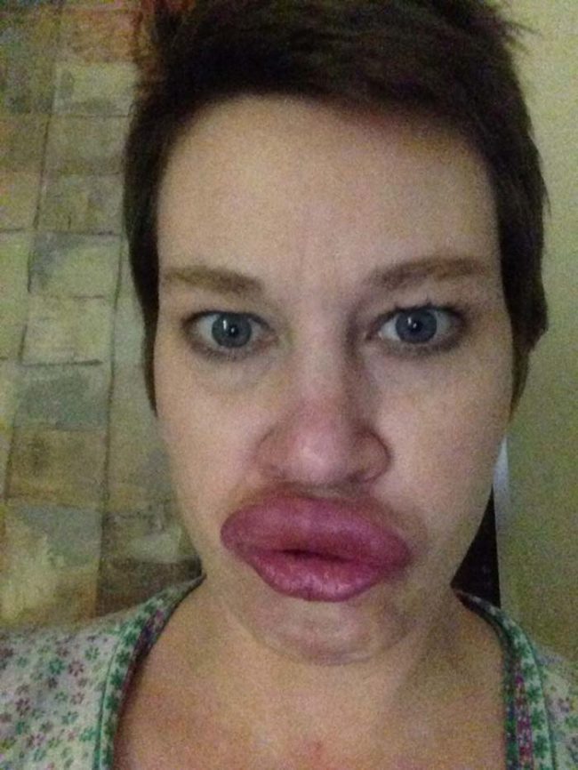 reaksi alergi © 2016 brilio.net reaksi alergi © 2016 brilio.net