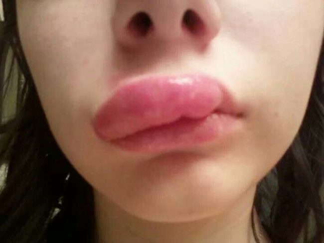 reaksi alergi © 2016 brilio.net reaksi alergi © 2016 brilio.net