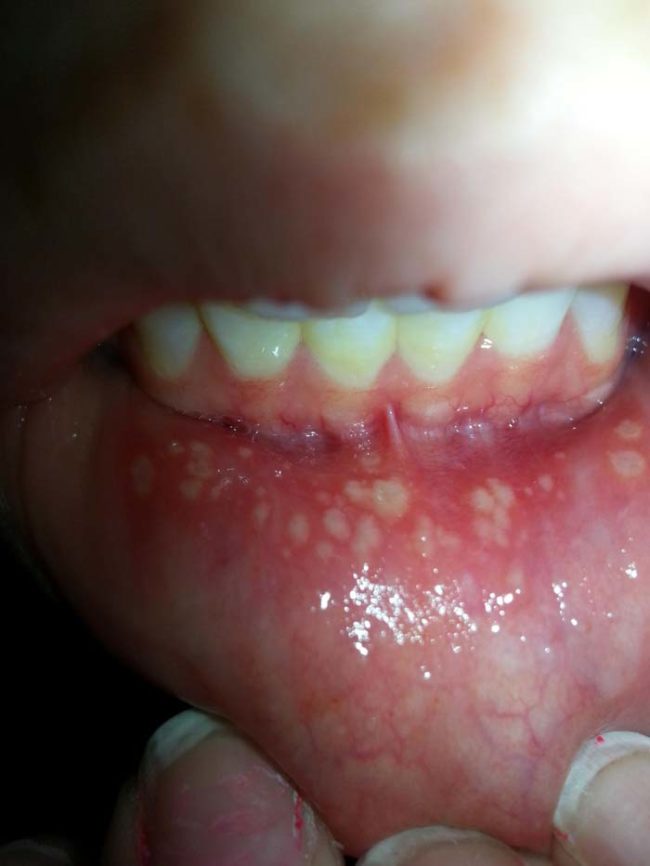 reaksi alergi © 2016 brilio.net reaksi alergi © 2016 brilio.net