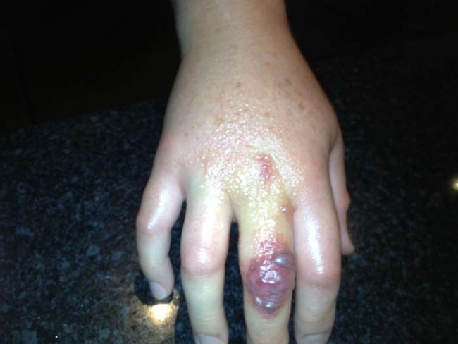 reaksi alergi © 2016 brilio.net reaksi alergi © 2016 brilio.net