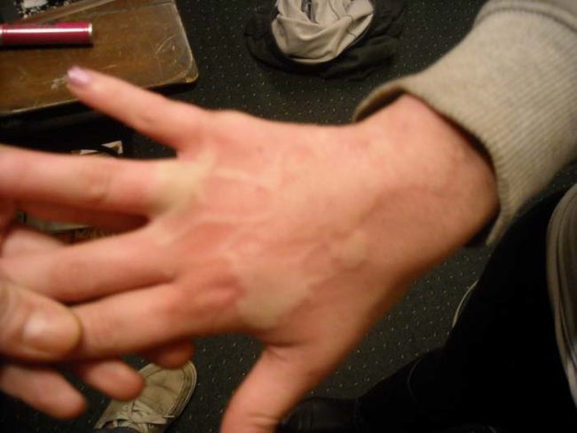 reaksi alergi © 2016 brilio.net reaksi alergi © 2016 brilio.net